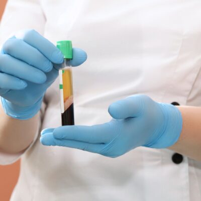 Blood plasma in hands for PRP therapy